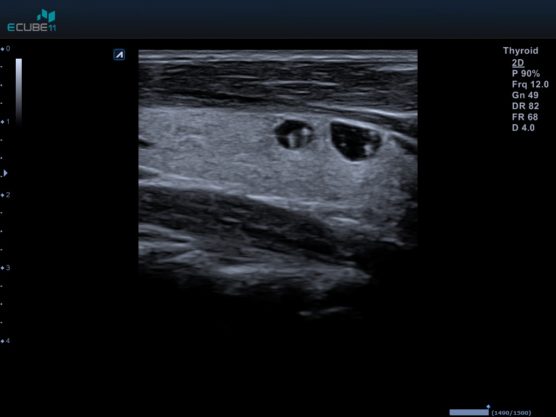 14 Multiple Colloid Cysts In Thyroid Spotmed 